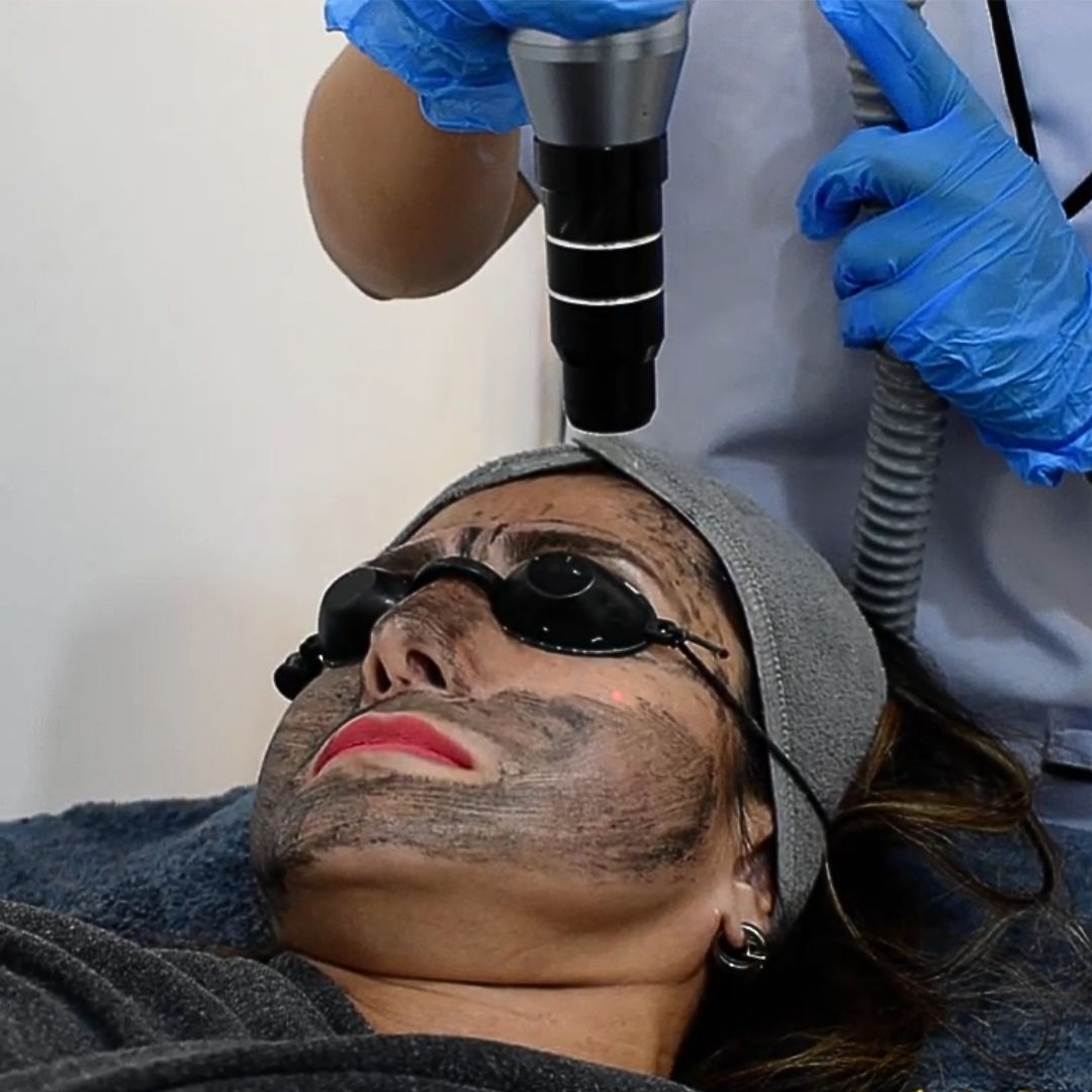 Carbon laser skin treatment