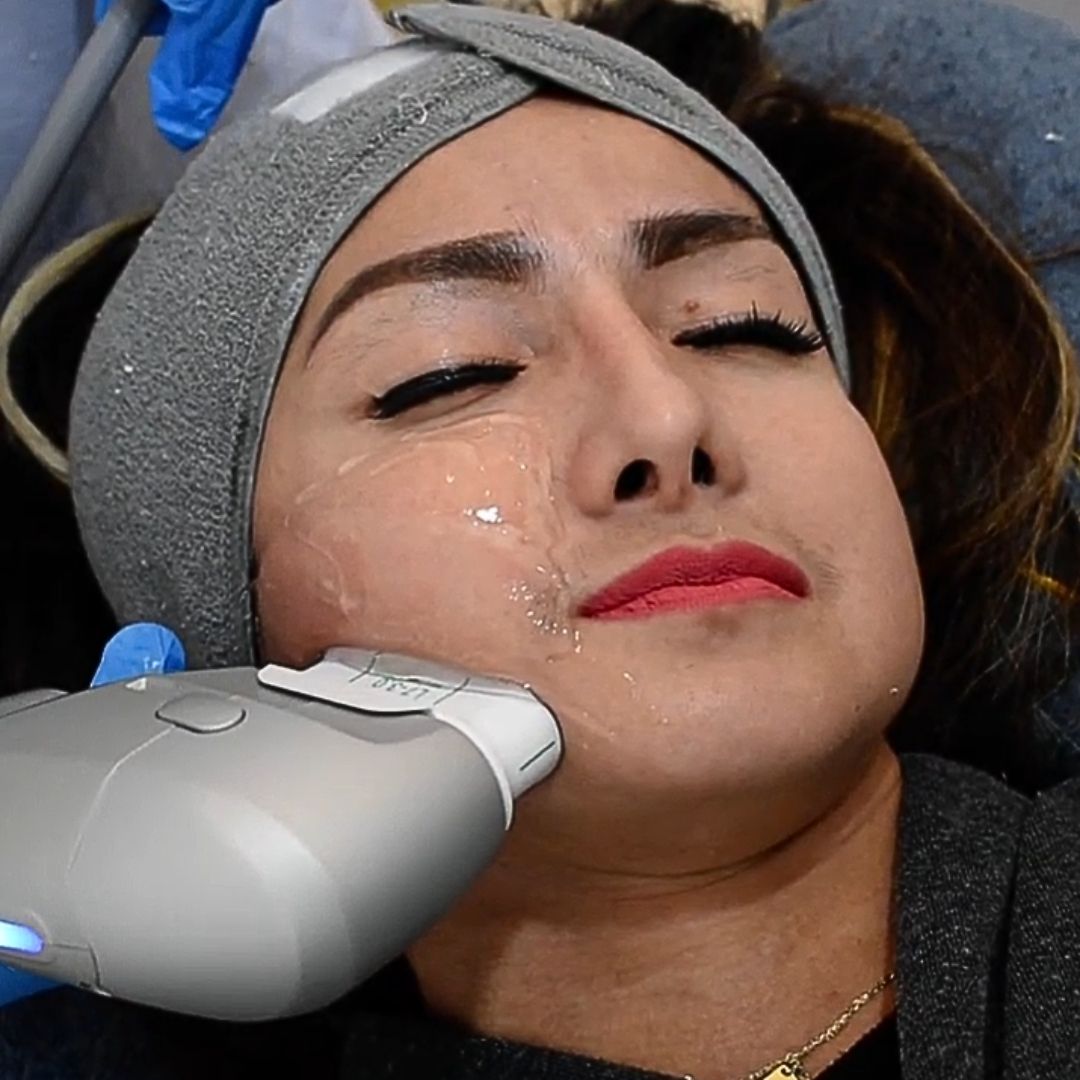 HIFU 7D facial lifting treatment
